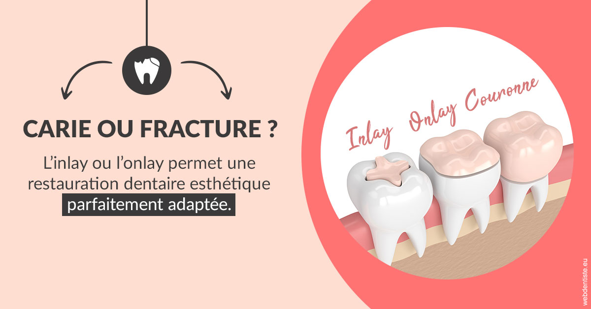 https://dr-janvier-guillemette.chirurgiens-dentistes.fr/T2 2023 - Carie ou fracture 2