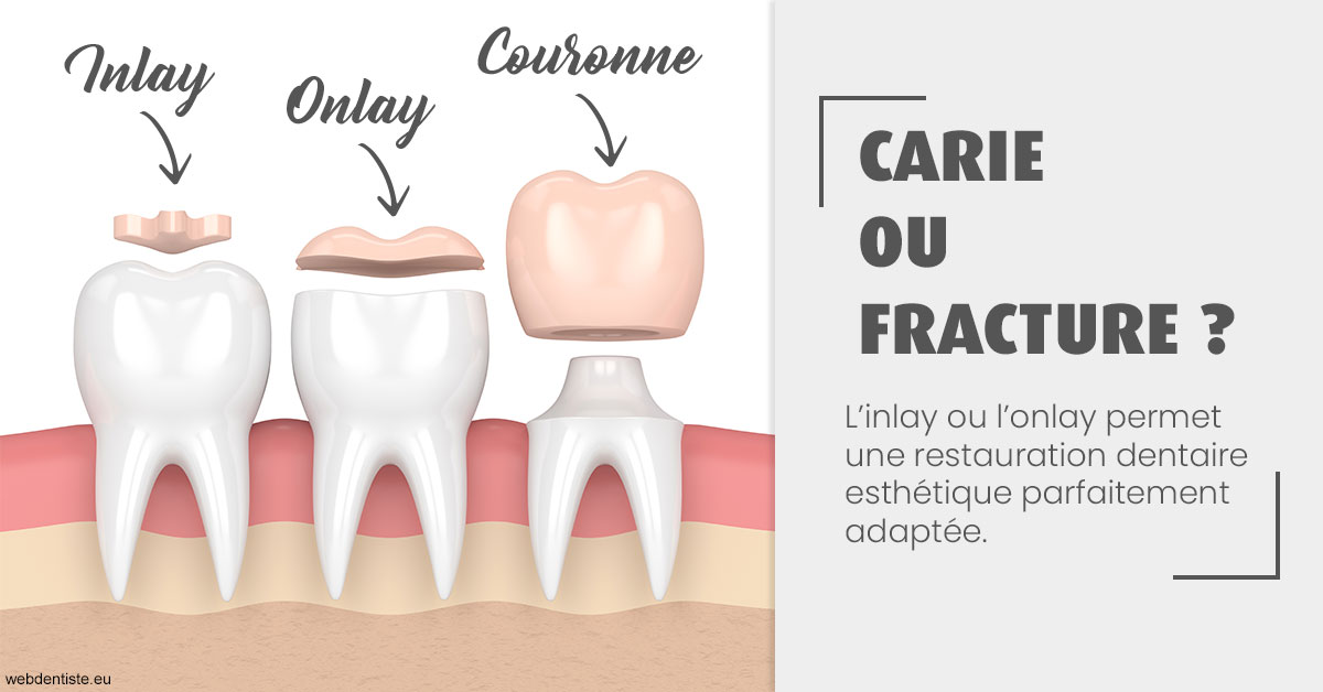 https://dr-janvier-guillemette.chirurgiens-dentistes.fr/T2 2023 - Carie ou fracture 1