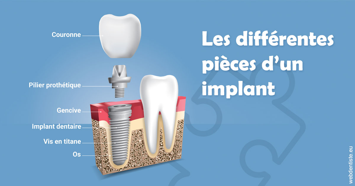 https://dr-janvier-guillemette.chirurgiens-dentistes.fr/Les différentes pièces d’un implant 1