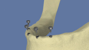 Stabilisation d'une prothèse par une barre sur 4 implants